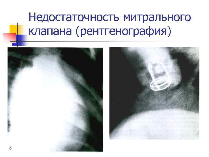 Недостаточность митрального клапана студфайл