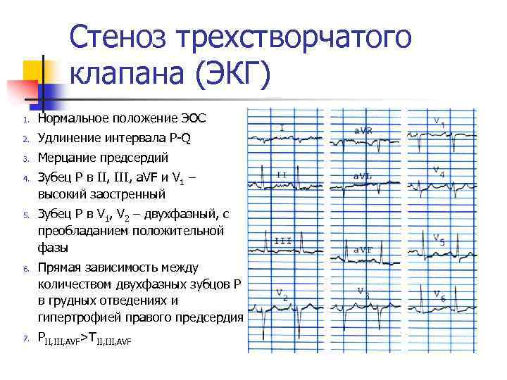 Порок трикуспидального клапана. Стеноз трехстворчатого клапана ЭКГ. Трикуспидальный стеноз ЭКГ. ЭКГ при трикуспидальной недостаточности. Пороки трехстворчатого клапана на ЭКГ.