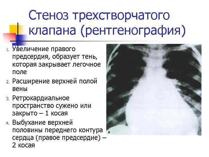 Недостаточность трикуспидального клапана степени