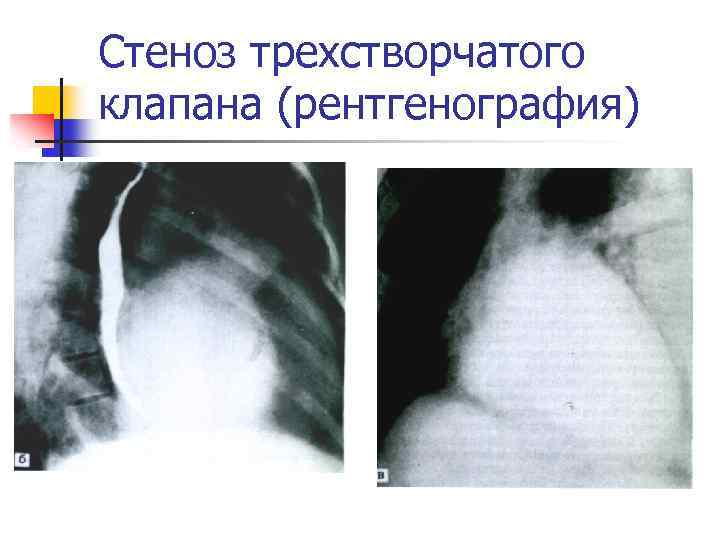 Недостаточность трикуспидального клапана степени