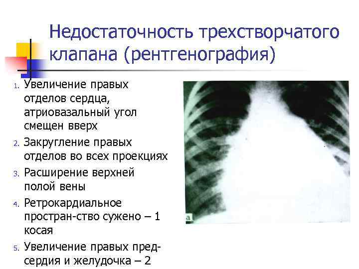 Увеличение правого. Конфигурация сердца при недостаточности трехстворчатого клапана. Недостаточность аортального клапана рентген. Трикуспидальная конфигурация сердца рентген. Рентгенологические признаки недостаточности аортального клапана.