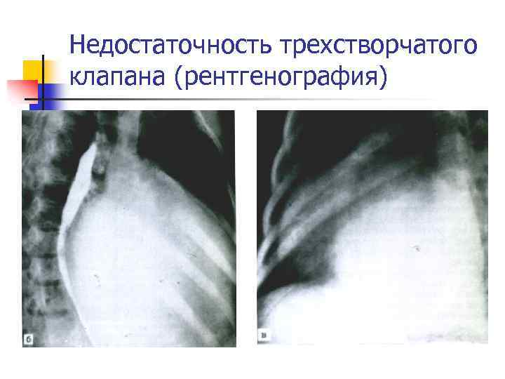 Недостаточность трикуспидального клапана степени