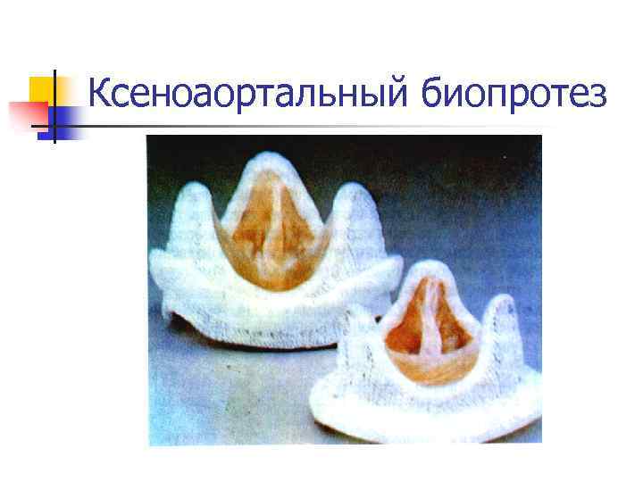 Ксеноаортальный биопротез 