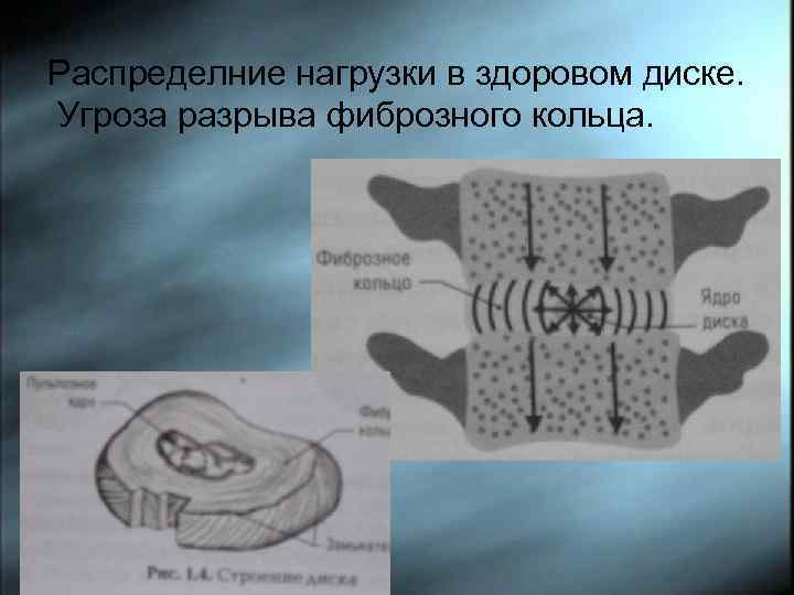 Распределние нагрузки в здоровом диске. Угроза разрыва фиброзного кольца. 