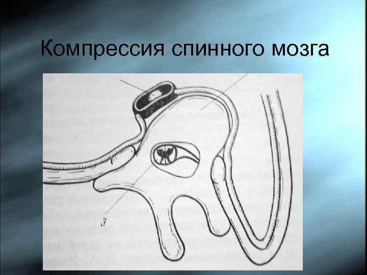 Компрессия спинного мозга 