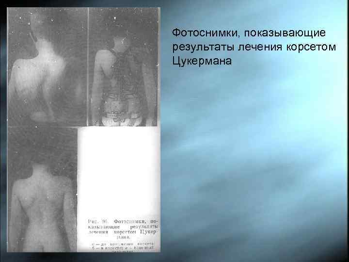 Фотоснимки, показывающие результаты лечения корсетом Цукермана 
