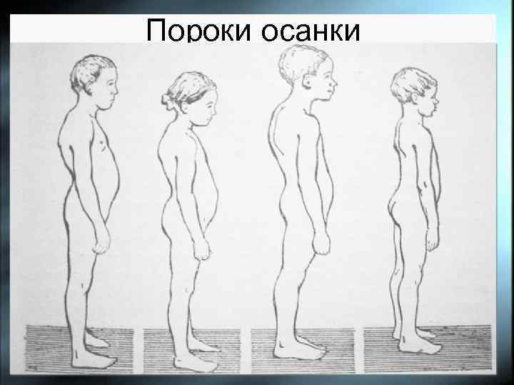 Пороки осанки 