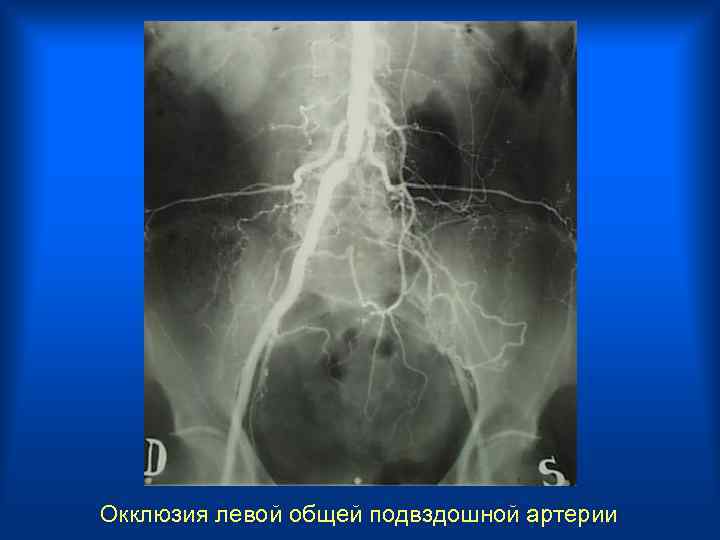 Окклюзия левой общей подвздошной артерии 