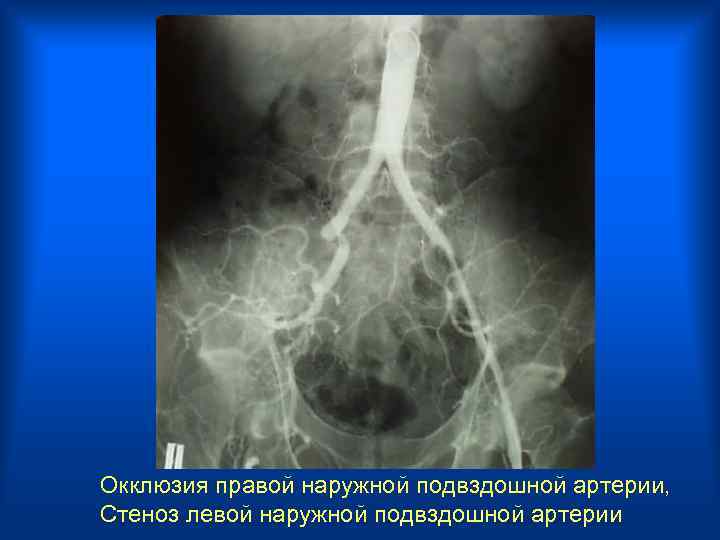 Окклюзия правой наружной подвздошной артерии, Стеноз левой наружной подвздошной артерии 