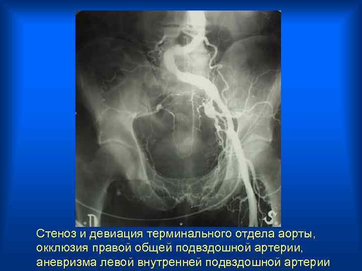Стеноз и девиация терминального отдела аорты, окклюзия правой общей подвздошной артерии, аневризма левой внутренней