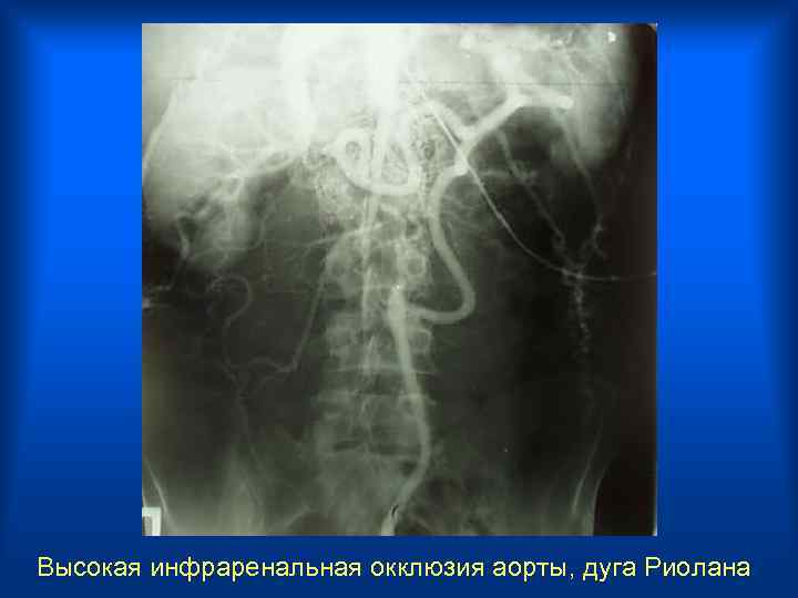 Высокая инфраренальная окклюзия аорты, дуга Риолана 