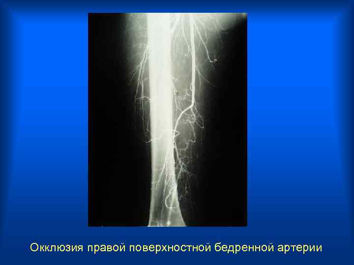 Окклюзия правой поверхностной бедренной артерии 
