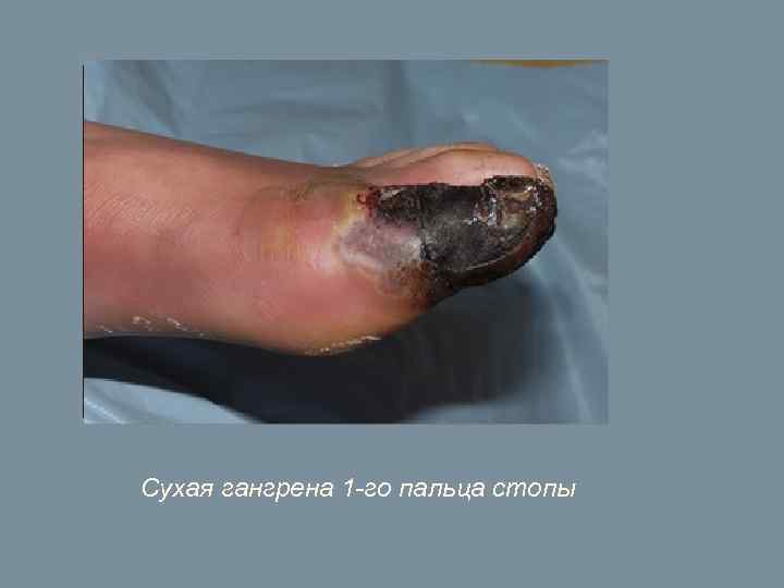 Сухая гангрена 1 -го пальца стопы 