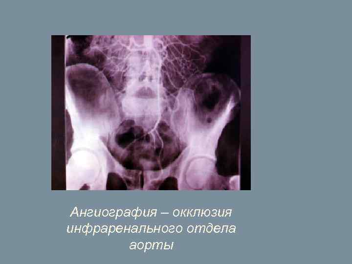 Ангиография – окклюзия инфраренального отдела аорты 