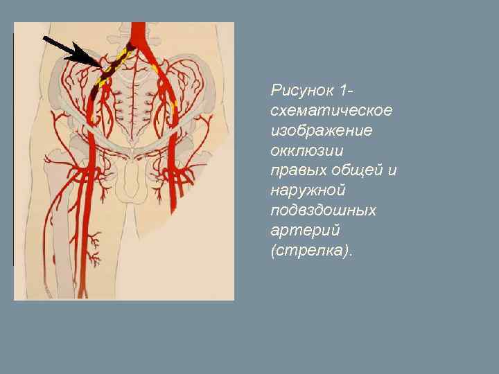 Рисунок 1 - схематическое изображение окклюзии правых общей и наружной подвздошных артерий (стрелка). 