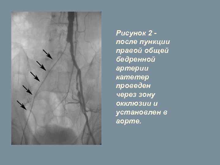 Рисунок 2 после пункции правой общей бедренной артерии катетер проведен через зону окклюзии и