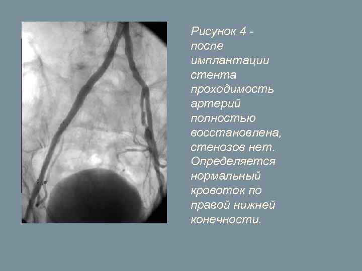 Рисунок 4 - после имплантации стента проходимость артерий полностью восстановлена, стенозов нет. Определяется нормальный