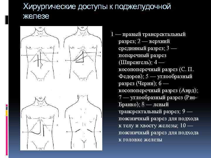 Хирургические доступы к поджелудочной железе 1 — правый трансректальный разрез; 2 — верхний срединный