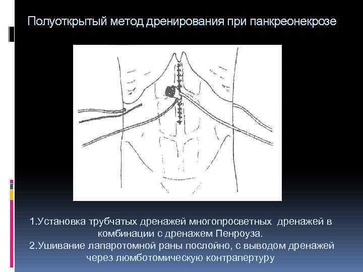 Полуоткрытый метод дренирования при панкреонекрозе 1. Установка трубчатых дренажей многопросветных дренажей в комбинации с