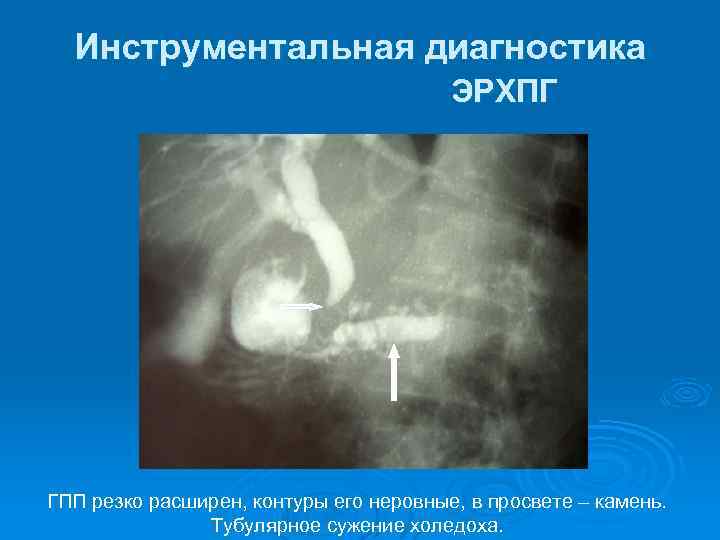 Инструментальная диагностика ЭРХПГ ГПП резко расширен, контуры его неровные, в просвете – камень. Тубулярное