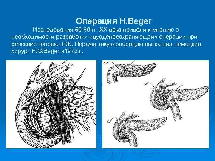 Операция фрея на поджелудочной железе схема