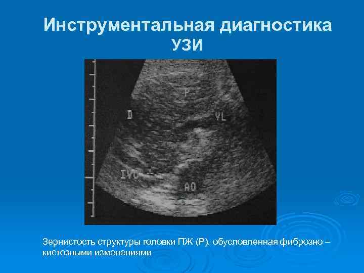 Инструментальная диагностика УЗИ Зернистость структуры головки ПЖ (P), обусловленная фиброзно – кистозными изменениями 