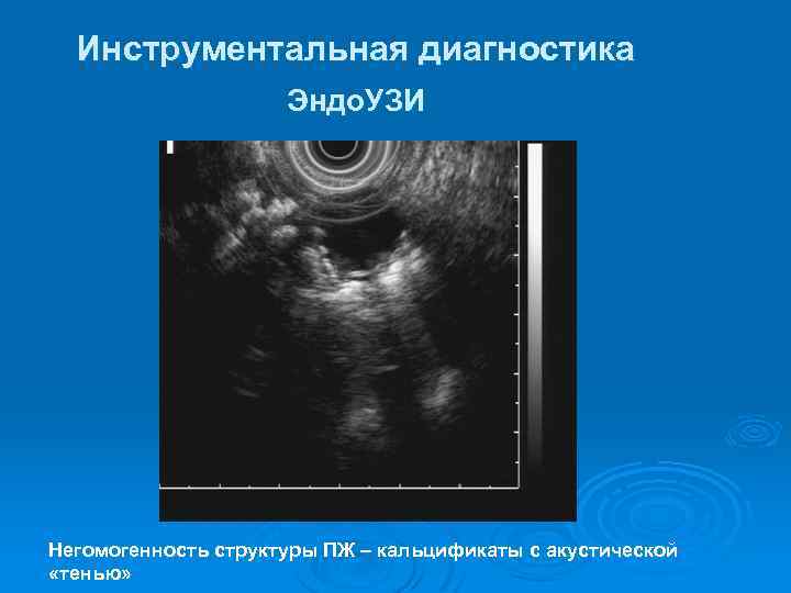 Инструментальная диагностика Эндо. УЗИ Негомогенность структуры ПЖ – кальцификаты с акустической «тенью» 