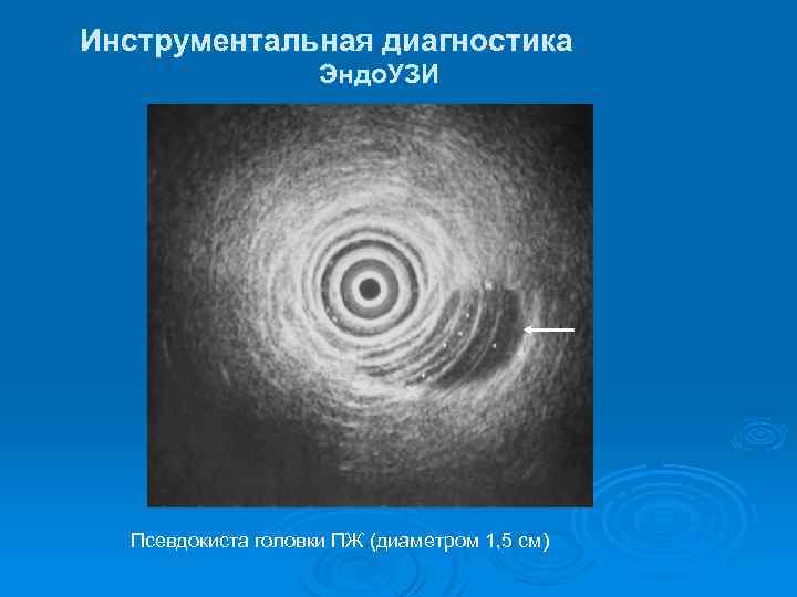 Инструментальная диагностика Эндо. УЗИ Псевдокиста головки ПЖ (диаметром 1, 5 см) 