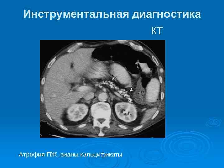 Инструментальная диагностика КТ Атрофия ПЖ, видны кальцификаты 