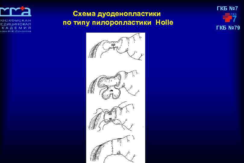 Схема дуоденопластики по типу пилоропластики Holle ГКБ № 79 