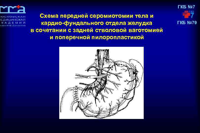 ГКБ № 7 Схема передней серомиотомии тела и кардио-фундального отдела желудка в сочетании с