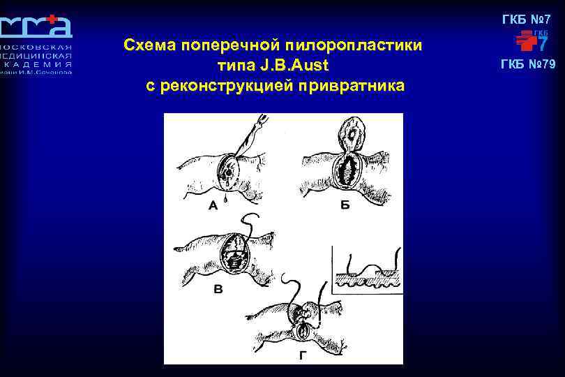 ГКБ № 7 Схема поперечной пилоропластики типа J. B. Aust с реконструкцией привратника ГКБ