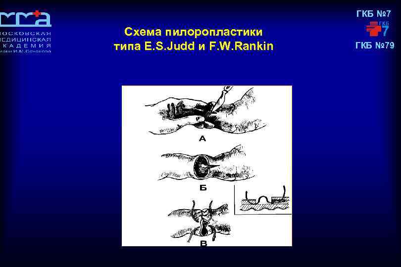 ГКБ № 7 Схема пилоропластики типа E. S. Judd и F. W. Rankin ГКБ