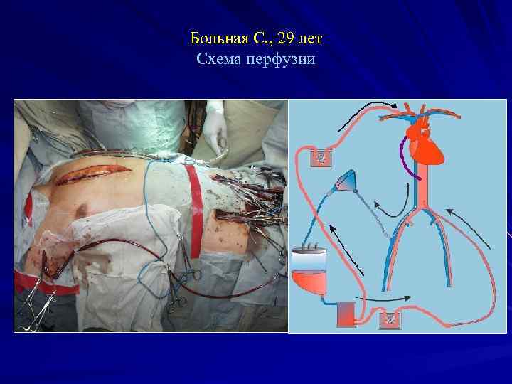 Больная С. , 29 лет Схема перфузии 