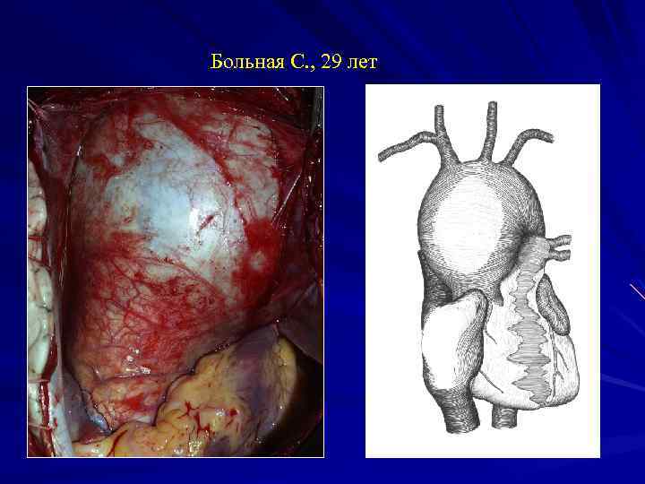 Больная С. , 29 лет 