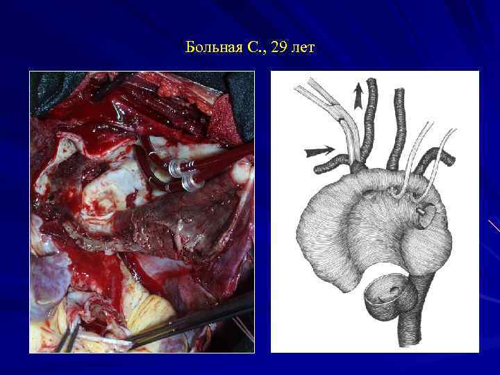 Больная С. , 29 лет 