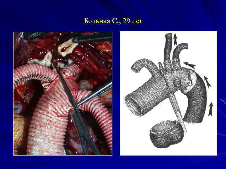 Больная С. , 29 лет 