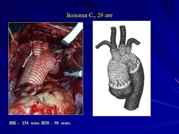 Больная С. , 29 лет ИК – 234 мин. ИМ – 91 мин. 