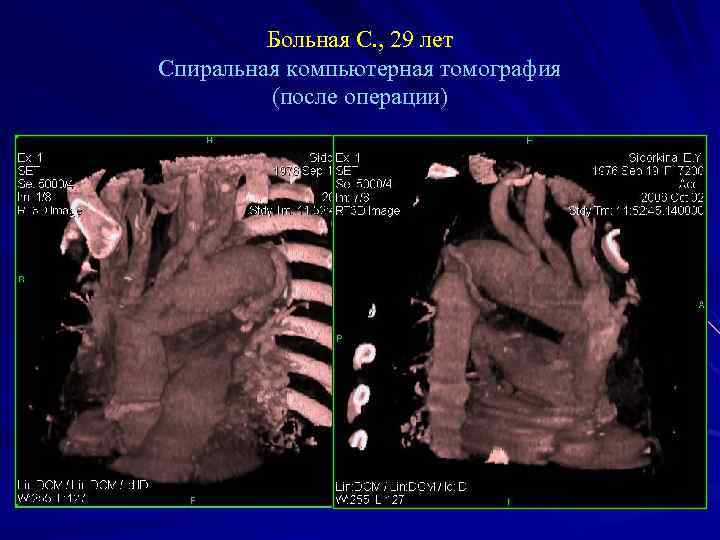 Больная С. , 29 лет Спиральная компьютерная томография (после операции) 