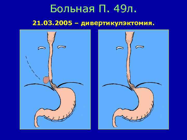 Больная П. 49 л. 21. 03. 2005 – дивертикулэктомия. 