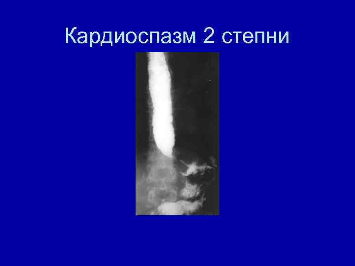 Кардиоспазм 2 степни 