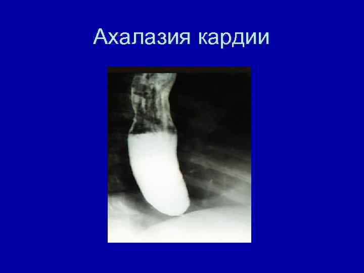 Ахалазия кардии 
