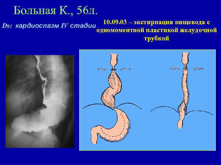 Больная К. , 56 л. Ds: кардиоспазм IV стадии 10. 09. 03 – экстирпация