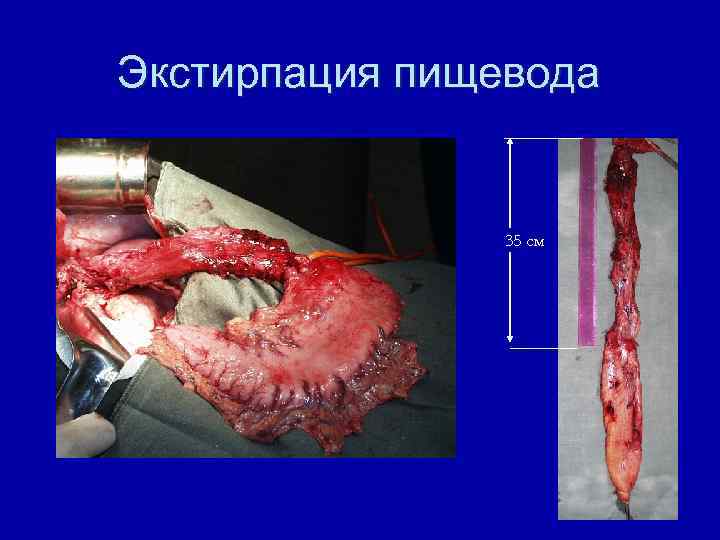 Экстирпация пищевода 35 см 