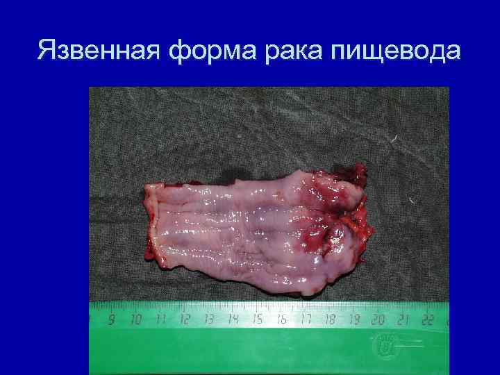 Язвенная форма рака пищевода 