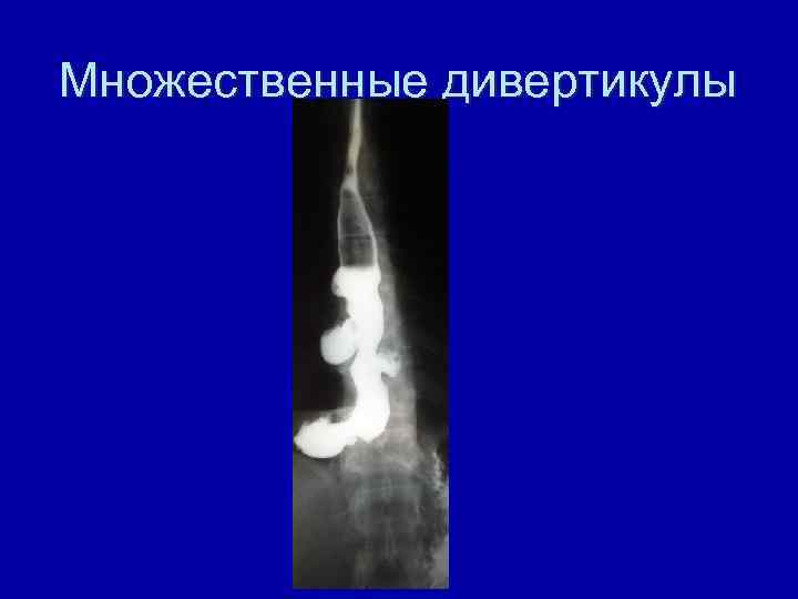 Множественные дивертикулы 