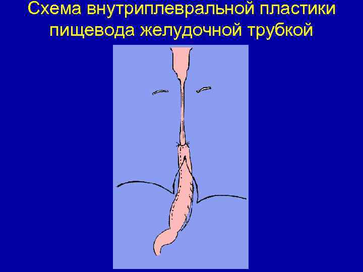 Схема внутриплевральной пластики пищевода желудочной трубкой 