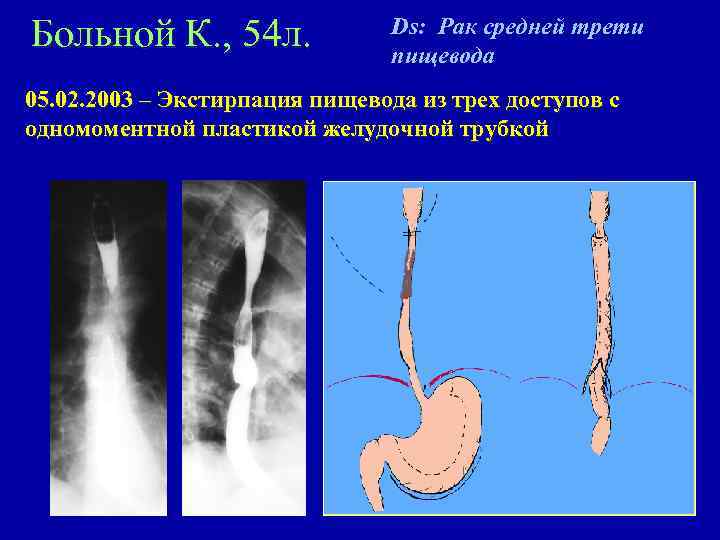 Больной К. , 54 л. Ds: Рак средней трети пищевода 05. 02. 2003 –