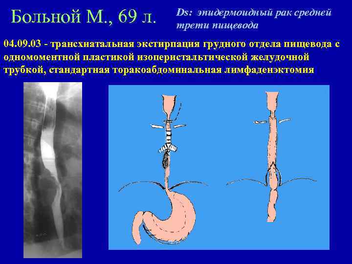 Зно пищевода карта вызова