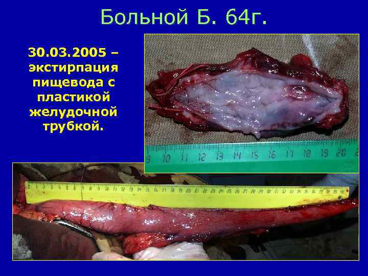 Больной Б. 64 г. 30. 03. 2005 – экстирпация пищевода с пластикой желудочной трубкой.